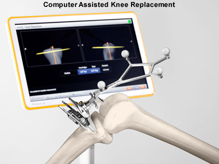 Robotik Navigasyonlu Diz Protezi Ameliyatında Hata Payı 1 mm’ye Düşüyor!